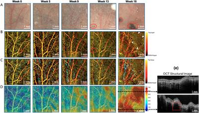 Applications of Multi-Contrast Optical Coherence Tomography in Assessment of Dysplastic Nevi to Malignant Melanoma